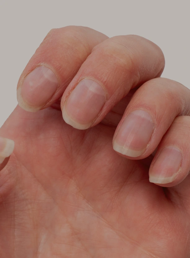 Unghii exfoliate și cuticule uscate